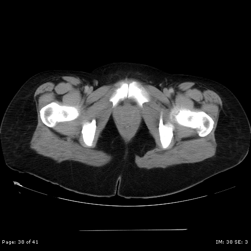 File:Abdominal wall endometriosis (Radiopaedia 25723-25885 Axial C+ portal venous phase 38).jpg