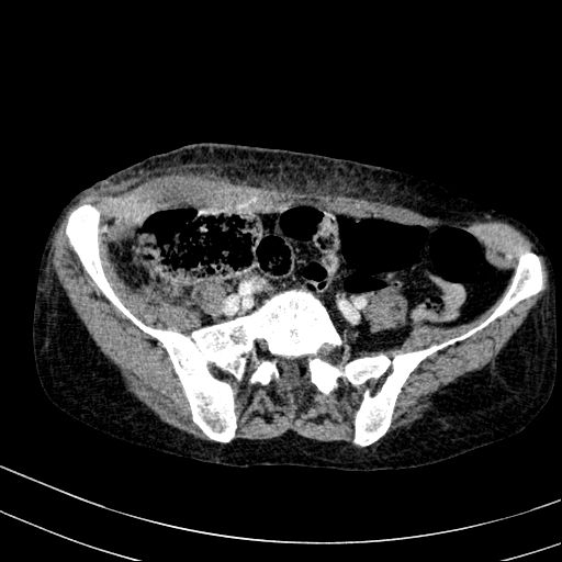 File:Abdominal wall hematoma with active bleeding (Radiopaedia 83915-99117 Axial C+ portal venous phase 92).jpg