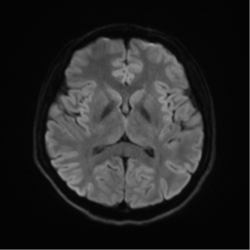 Abducens nerve palsy (Radiopaedia 51069-56648 Axial DWI 41).png
