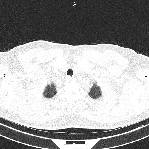 Aberrant right subclavian artery (Radiopaedia 87093-103354 Axial lung window 10).jpg