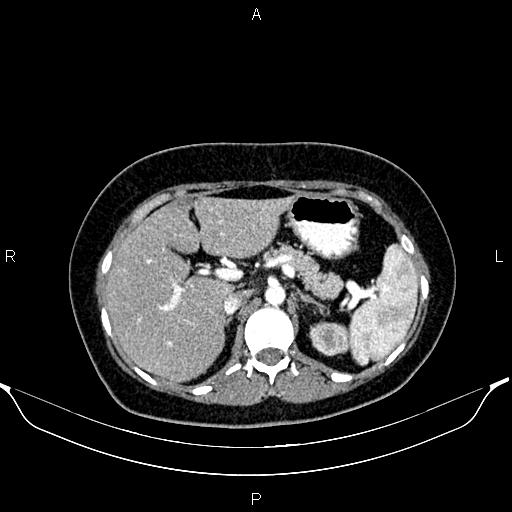 Aberrant right subclavian artery (Radiopaedia 87334-103629 Axial C+ arterial phase 71).jpg