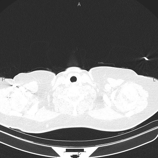 Aberrant right subclavian artery (Radiopaedia 87334-103629 Axial lung window 3).jpg