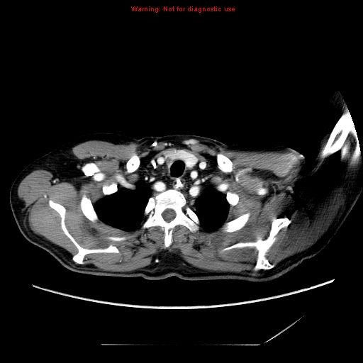 Aberrant right subclavian artery (Radiopaedia 9379-10071 Axial C+ arterial phase 8).jpg