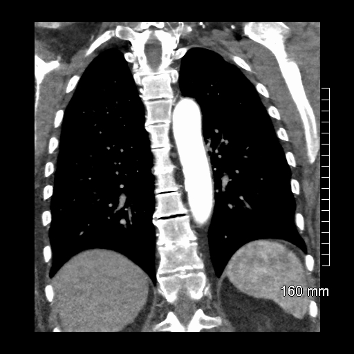 Aberrant right subclavian artery stenosis (Radiopaedia 52656-58670 B 62).jpg