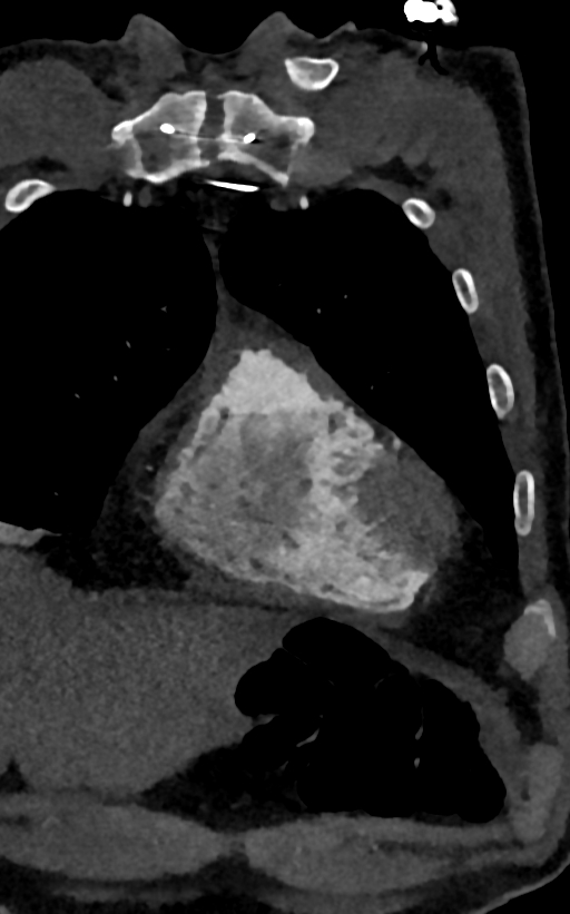 Accessory left atrial appendage (Radiopaedia 81987-95968 Coronal C+ arterial phase 8).jpg