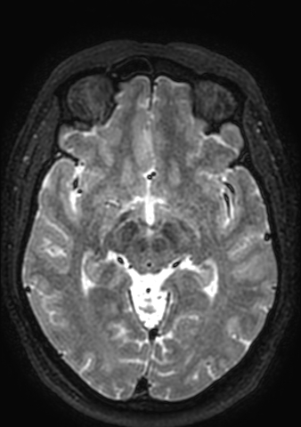 File:Accessory middle cerebral artery (Radiopaedia 73114-83828 Axial T2 97).jpg