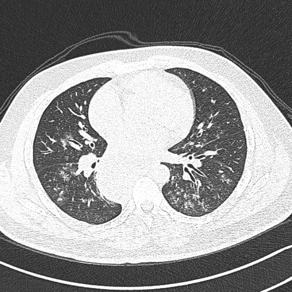 Achalasia with aspiration (Radiopaedia 55413-61845 Axial lung window 41).jpg