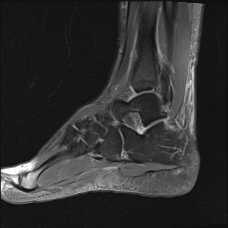 File:Achilles tendon tear (Radiopaedia 77615-89819 Sagittal PD fat sat 16).jpg