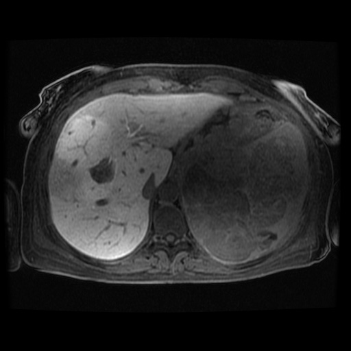 Acinar cell carcinoma of the pancreas (Radiopaedia 75442-86668 Axial late phase (~30 mins) 105).jpg