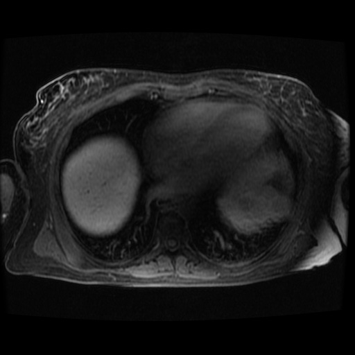 Acinar cell carcinoma of the pancreas (Radiopaedia 75442-86668 Axial late phase (~30 mins) 139).jpg