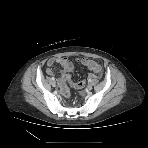 Acinar cell carcinoma of the pancreas (Radiopaedia 75442-86669 Axial C+ portal venous phase 117).jpg