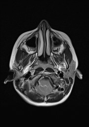 File:Acquired cerebellar tonsillar ectopia (Radiopaedia 39950-42423 Axial T2 2).jpg