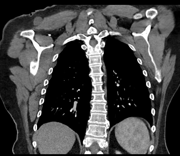 Acromioclavicular joint cyst (Radiopaedia 58455-65610 Coronal C+ arterial phase 105).jpg