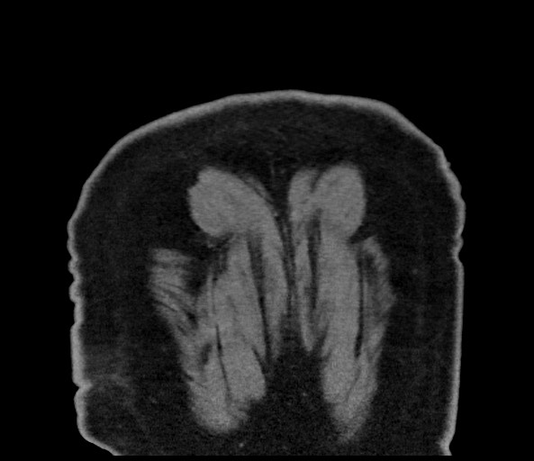 Acromioclavicular joint cyst (Radiopaedia 58455-65610 Coronal C+ arterial phase 136).jpg