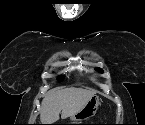 Acromioclavicular joint cyst (Radiopaedia 58455-65610 Coronal C+ arterial phase 32).jpg