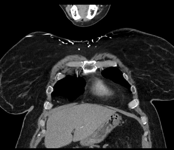 Acromioclavicular joint cyst (Radiopaedia 58455-65610 Coronal C+ arterial phase 36).jpg