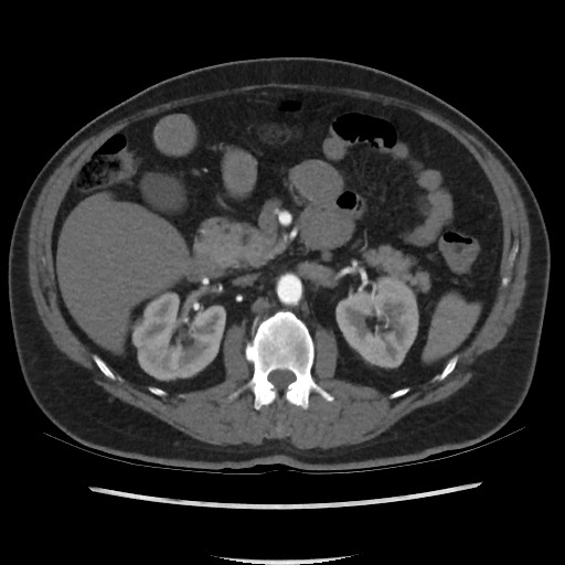 File:Active colonic bleed on CT (Radiopaedia 49765-55025 Axial C+ arterial phase 32).jpg