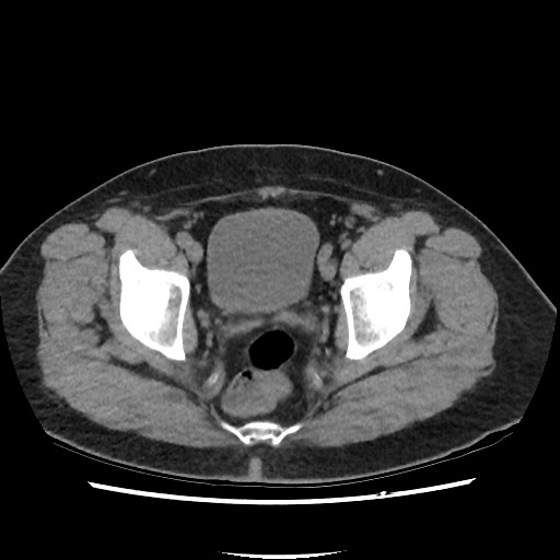Active colonic bleed on CT (Radiopaedia 49765-55025 Axial non-contrast 75).jpg