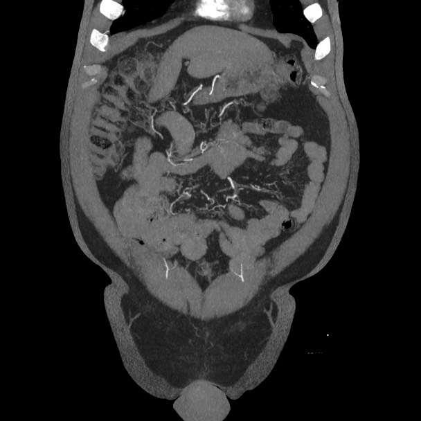 Active colonic bleed on CT (Radiopaedia 49765-55025 Coronal art MIP 18).jpg