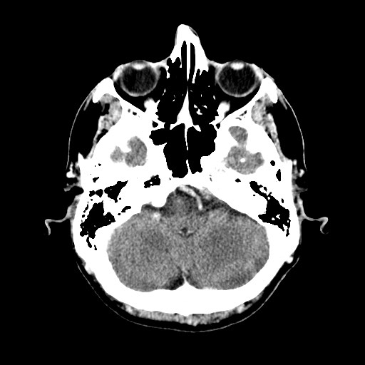 File:Active neurocysticercosis before and after therapy (Radiopaedia 71710-82100 Axial C+ delayed 12).jpg