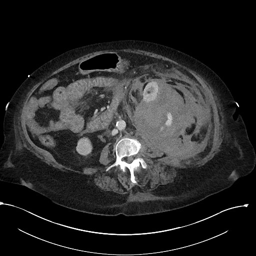 File:Active renal extravasation with large subcapsular and retroperitoneal hemorrhage (Radiopaedia 60975-68796 Axial 241).jpg