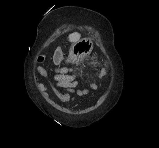 Active renal extravasation with large subcapsular and retroperitoneal hemorrhage (Radiopaedia 60975-68796 Coronal C+ portal venous phase 31).jpg