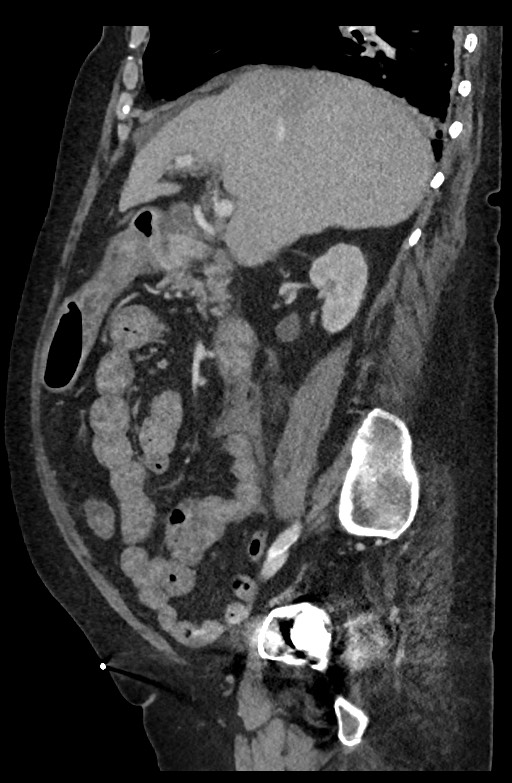 Active renal extravasation with large subcapsular and retroperitoneal hemorrhage (Radiopaedia 60975-68796 Sagittal C+ portal venous phase 143).jpg