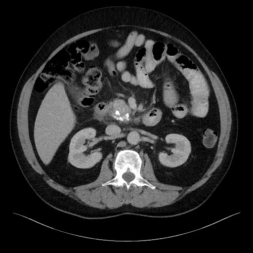 Acute-on-chronic pancreatitis (Radiopaedia 67286-76656 Axial C+ portal venous phase 33).jpg