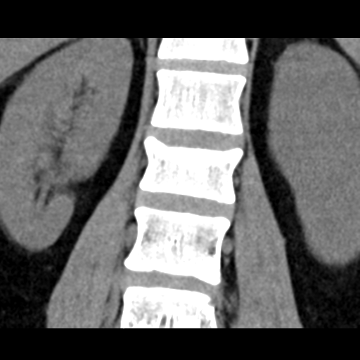 File:Acute L1 burst compression fracture (Radiopaedia 34430-35755 Axial non-contrast 1).png