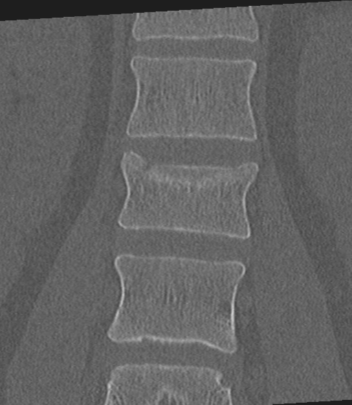 Acute L1 burst compression fracture (Radiopaedia 34430-35755 Coronal bone window 28).png