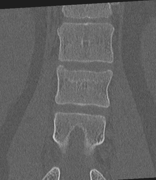 Acute L1 burst compression fracture (Radiopaedia 34430-35755 Coronal bone window 32).png