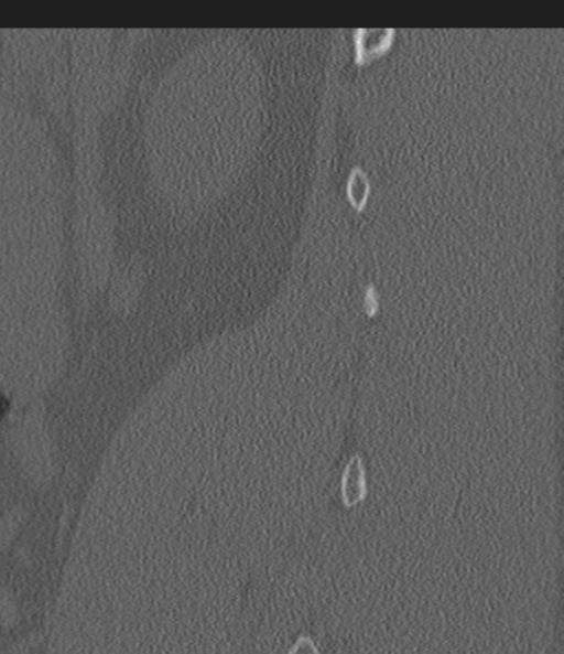 Acute L1 burst compression fracture (Radiopaedia 34430-35755 Sagittal bone window 55).png