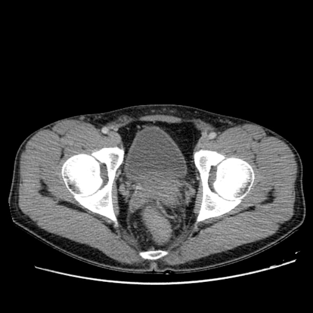 Acute appendicitis (Radiopaedia 27049-27227 Axial C+ portal venous phase 72).jpg