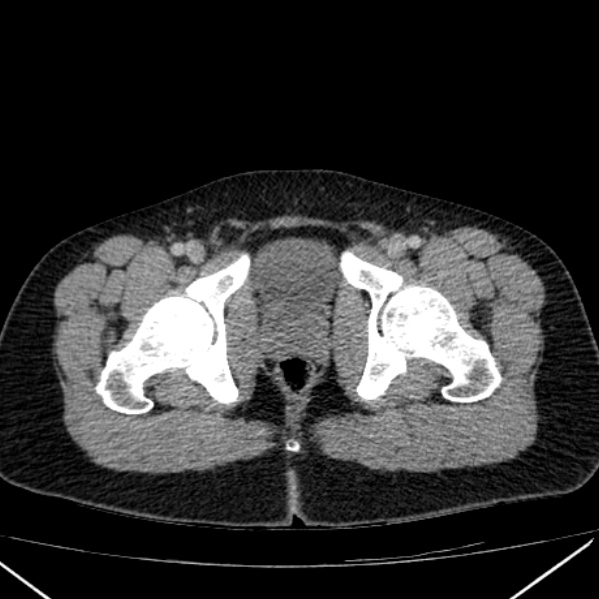Acute appendicitis (Radiopaedia 38255-40270 Axial C+ portal venous phase 110).jpg