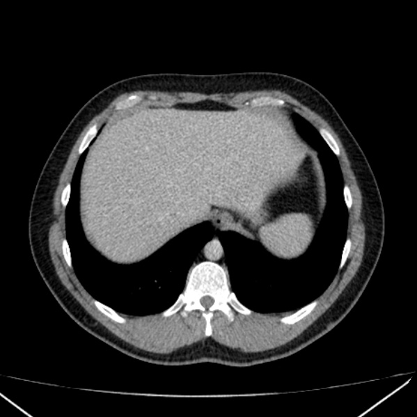 Acute appendicitis (Radiopaedia 38255-40270 Axial C+ portal venous phase 12).jpg