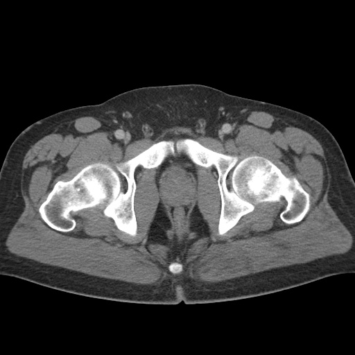 Acute appendicitis (Radiopaedia 48511-53463 Axial C+ portal venous phase 101).jpg