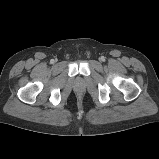 Acute appendicitis (Radiopaedia 48511-53463 Axial C+ portal venous phase 104).jpg