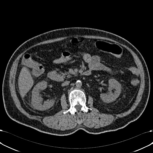 File:Acute appendicitis (Radiopaedia 58627-65818 Axial non-contrast 38).jpg