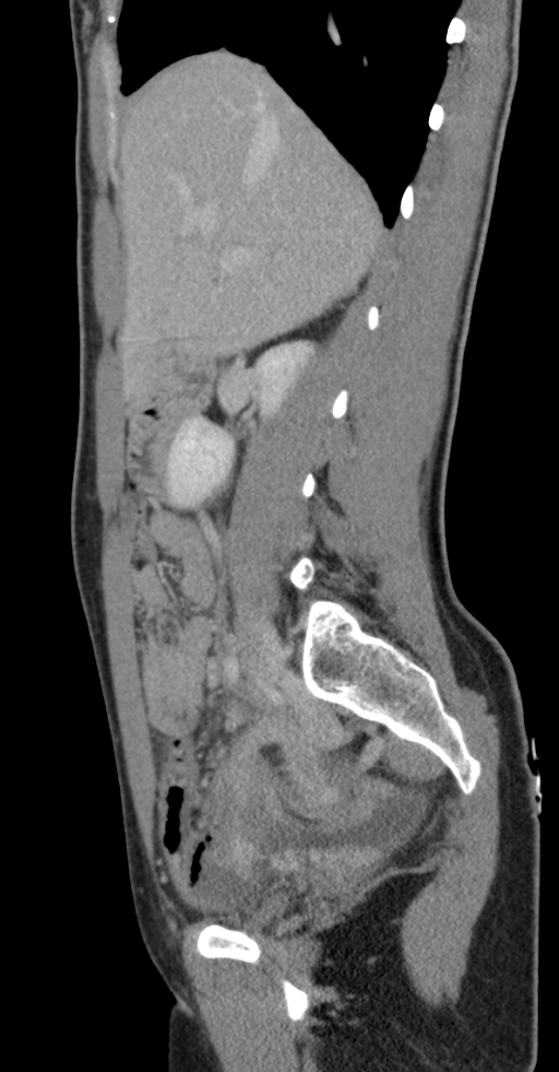 Acute appendicitis (Radiopaedia 62608-70901 Sagittal C+ portal venous phase 34).jpg