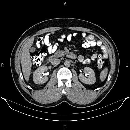 File:Acute appendicitis (Radiopaedia 84780-100240 Axial C+ delayed 42).jpg