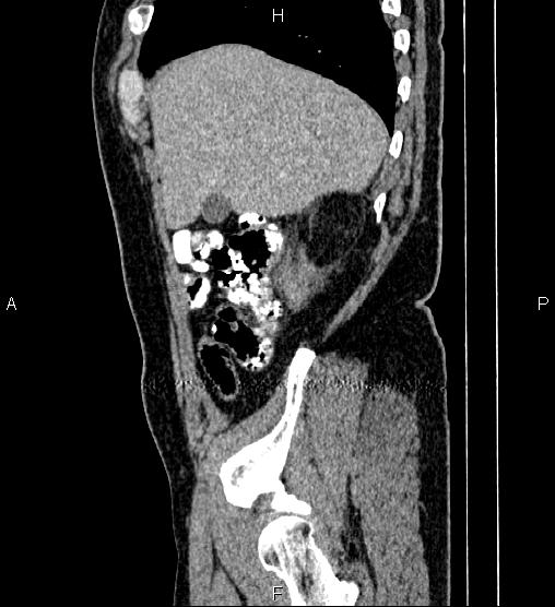 Acute appendicitis (Radiopaedia 84780-100240 Sagittal C+ portal venous phase 16).jpg