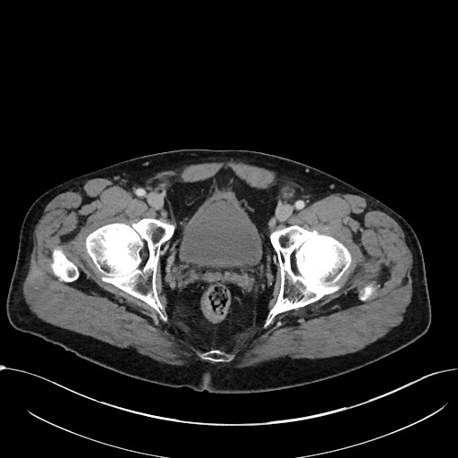Acute appendicitis - large appendicoliths (Radiopaedia 61805-69820 Axial C+ portal venous phase 123).jpg