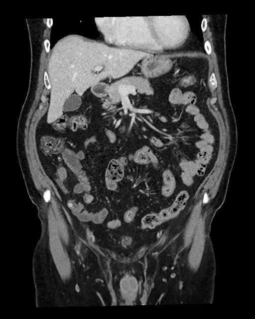 Acute appendicitis - large appendicoliths (Radiopaedia 61805-69820 Coronal C+ portal venous phase 49).jpg