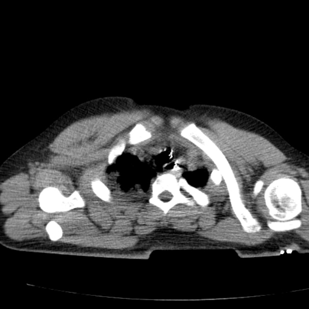 Acute aspiration pneumonitis (Radiopaedia 33605-34703 Axial non-contrast 22).jpg