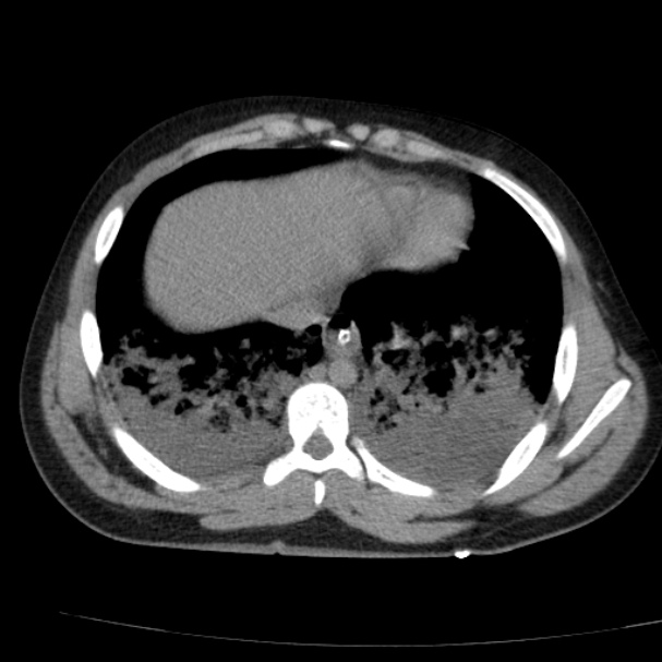 Acute aspiration pneumonitis (Radiopaedia 33605-34703 Axial non-contrast 63).jpg