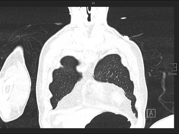 Acute aspiration pneumonitis (Radiopaedia 55642-62166 Coronal lung window 14).jpg