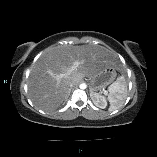 File:Acute bilateral pyelonephritis (Radiopaedia 37146-38881 Axial C+ arterial phase 37).jpg