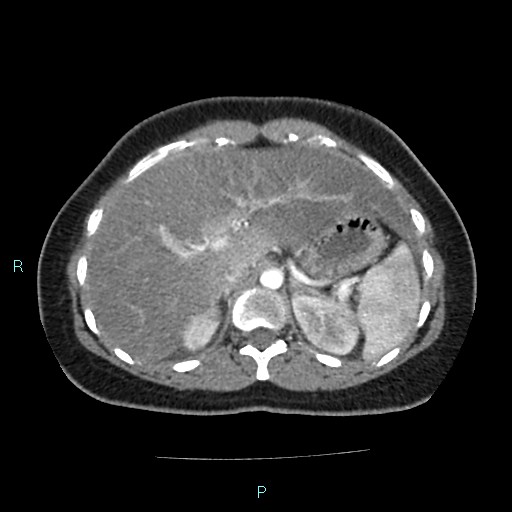 Acute bilateral pyelonephritis (Radiopaedia 37146-38881 Axial C+ arterial phase 43).jpg