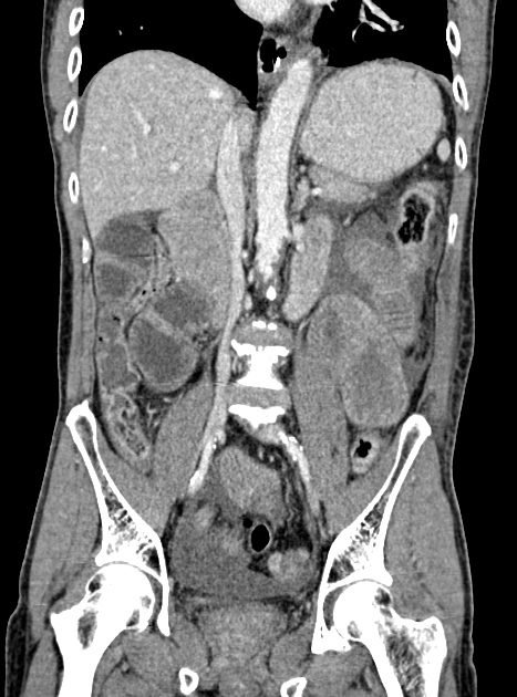 Acute bowel ischemia (Radiopaedia 87695-104114 Coronal C+ portal venous phase 219).jpg