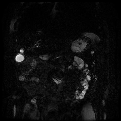 Acute cholecystitis and biliary hamartomas (Radiopaedia 86231-102240 E 117).jpg